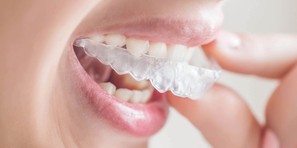 Elencia Aligners blog