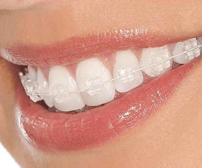 Eledent fixed brackets