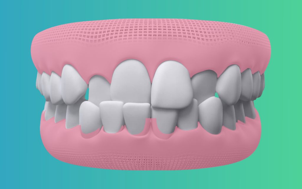 cross bites Elencia Aligners