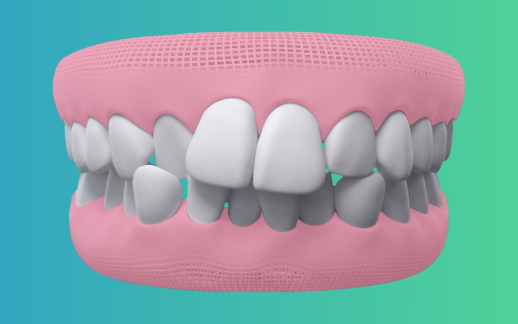 Crowded Teeth treatment in india by Elencia Aligners