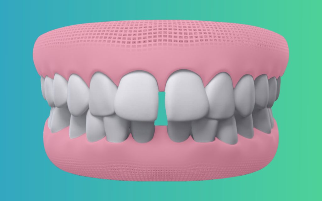 Gapped Teeth treatment in india by Elencia Aligners