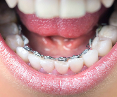 Lingual braces