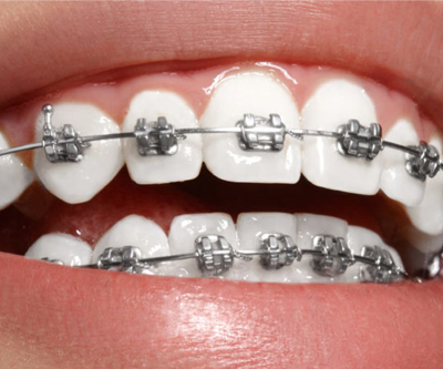 Metal braces