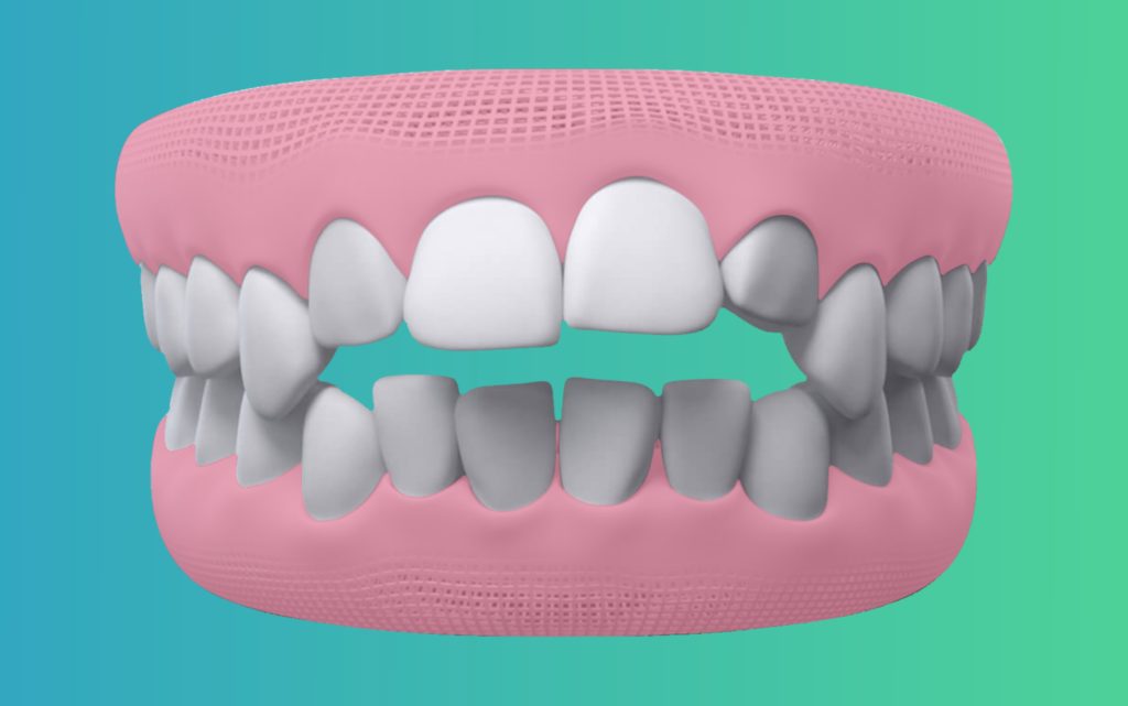 openbite Teeth treatment in india by Elencia Aligners