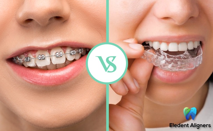 What is Invisible or Clear Aligner? Which is better Elencia Aligners or Braces