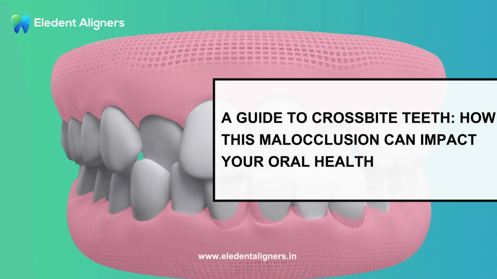 Crossbite Teeth