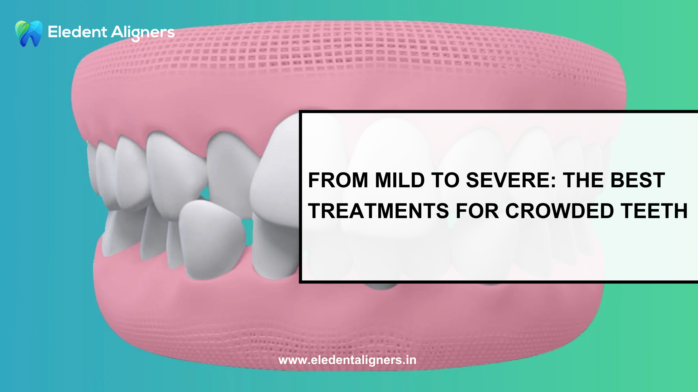 From Mild to Severe: The Best Treatments for Crowded Teeth