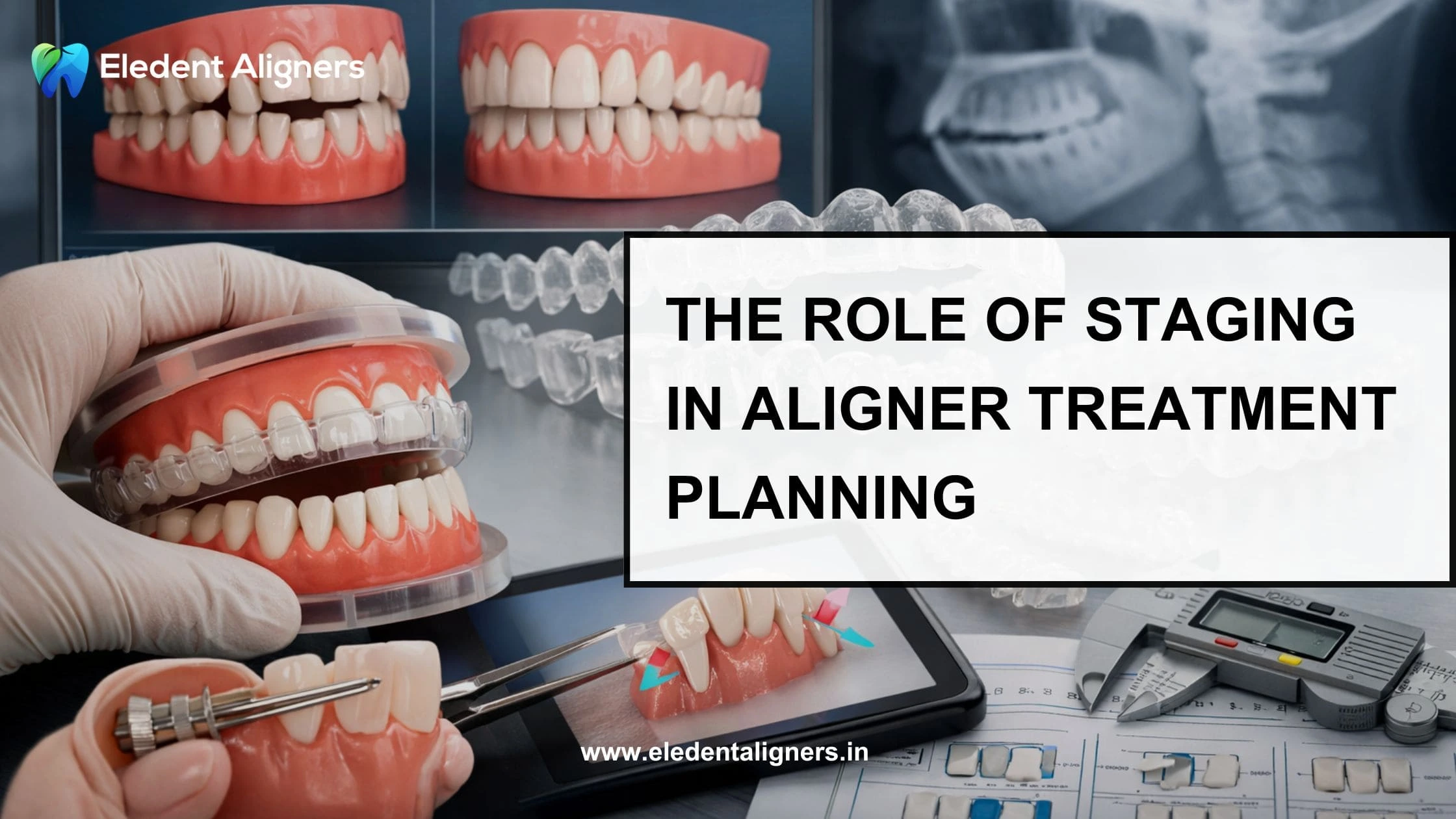 The Role of Staging in Aligner Treatment Planning