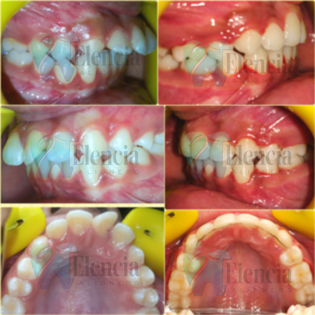 elencia aligners treatment before after image