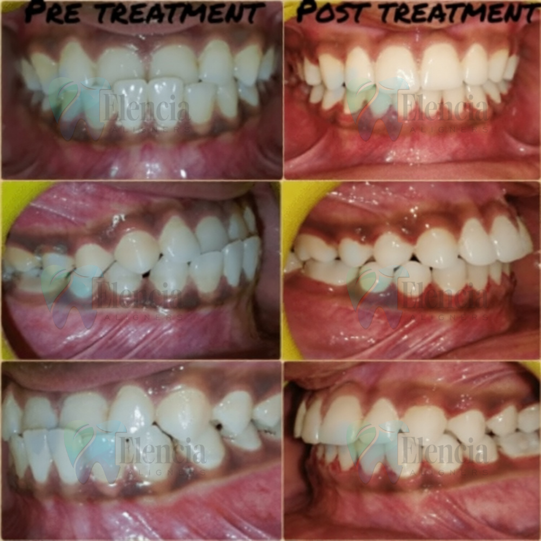 elencia aligners treatment before after image