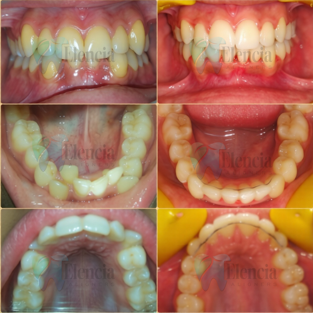 elencia aligners treatment before after image