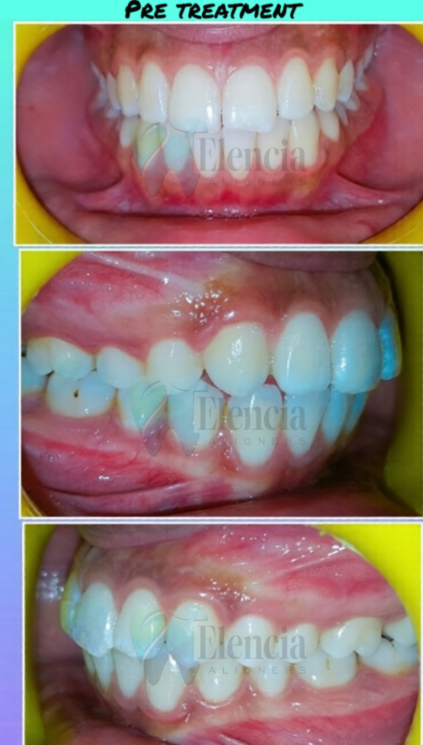 elencia aligners treatment before after image