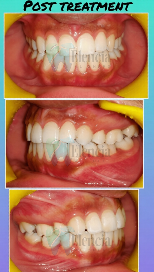 elencia aligners treatment before after image