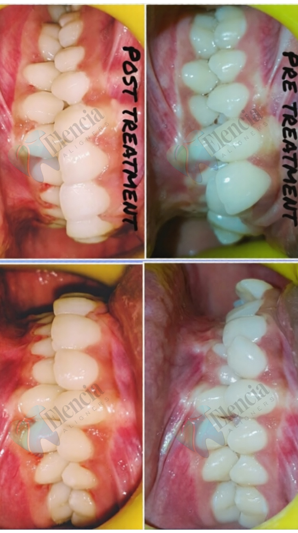 elencia aligners treatment before after image