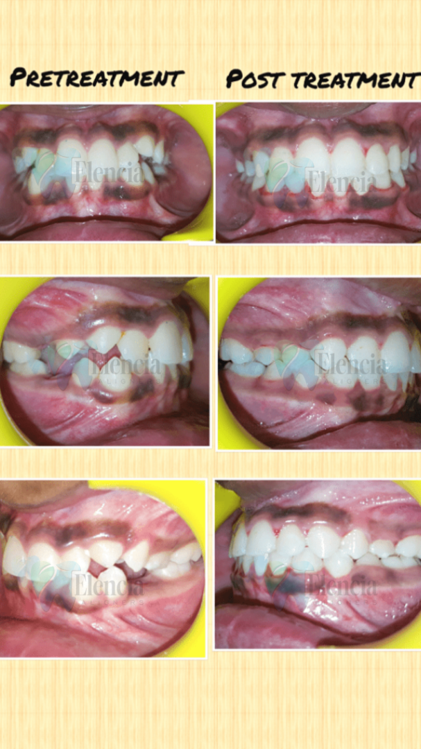 elencia aligners treatment before after image