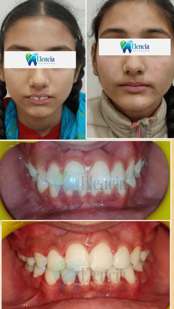elencia aligners treatment before after image