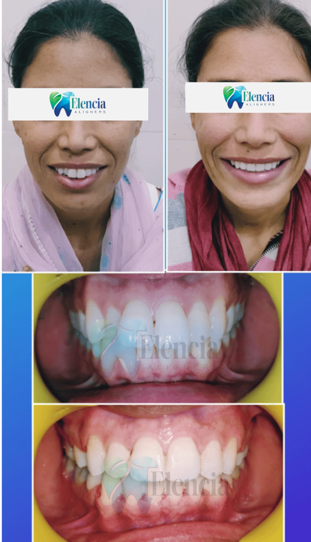 elencia aligners treatment before after image