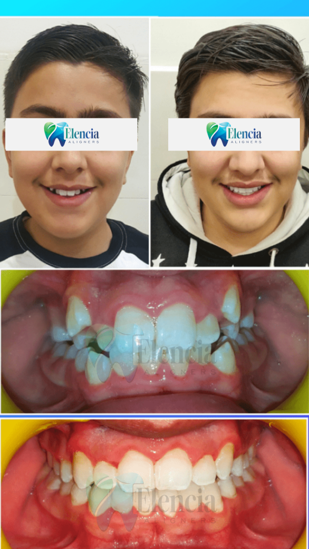 elencia aligners treatment before after image