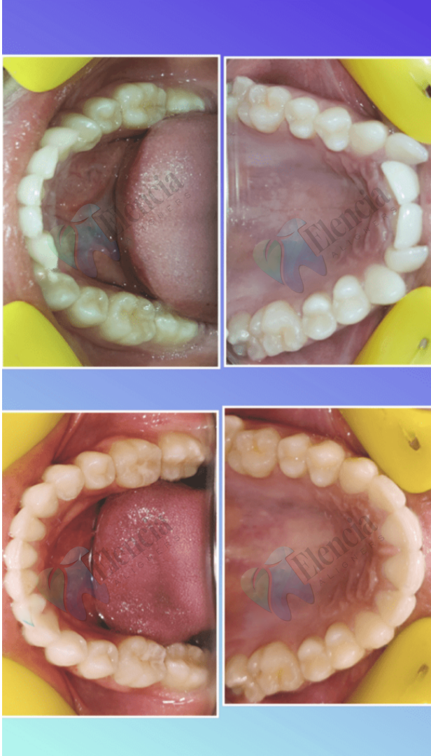elencia aligners treatment before after image