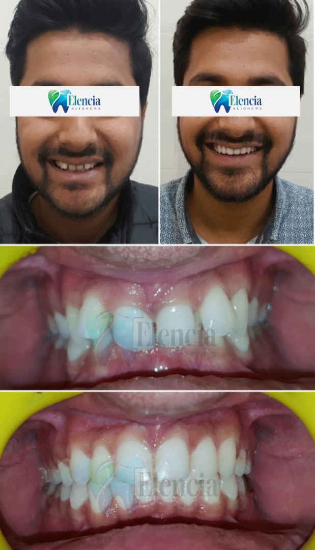 elencia aligners treatment before after image
