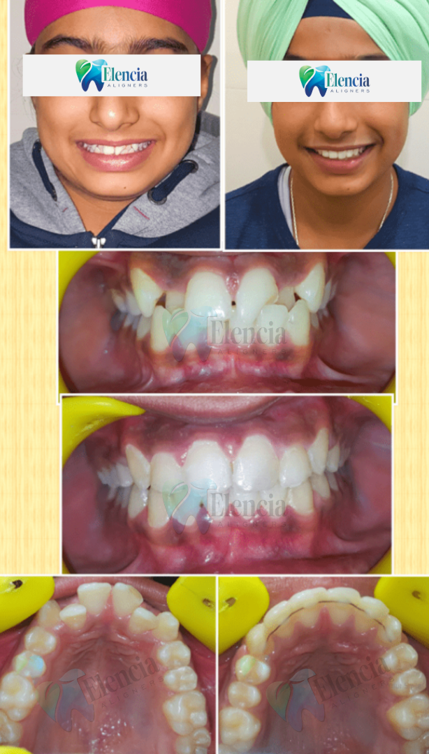 elencia aligners treatment before after image