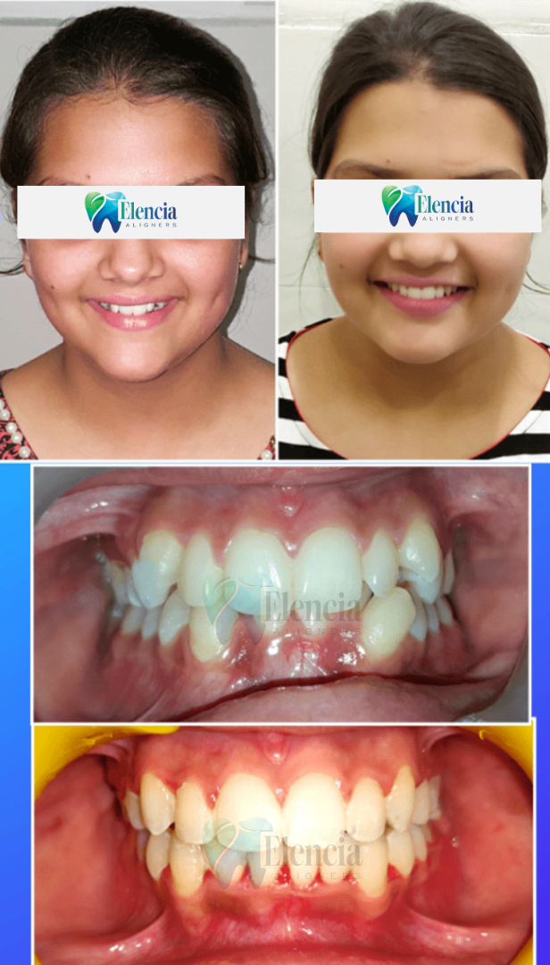 elencia aligners treatment before after image
