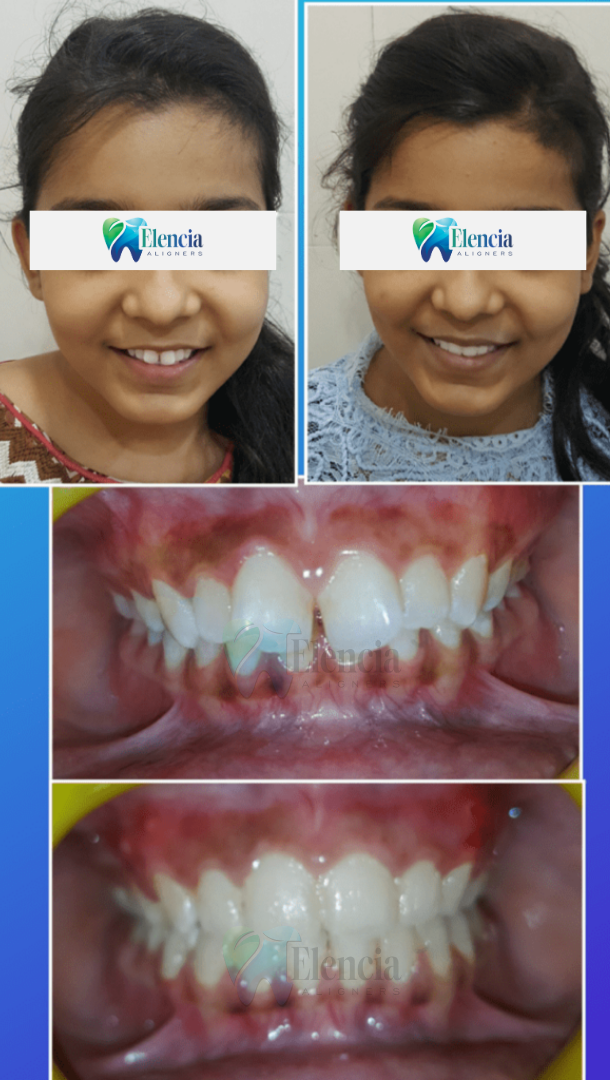 elencia aligners treatment before after image
