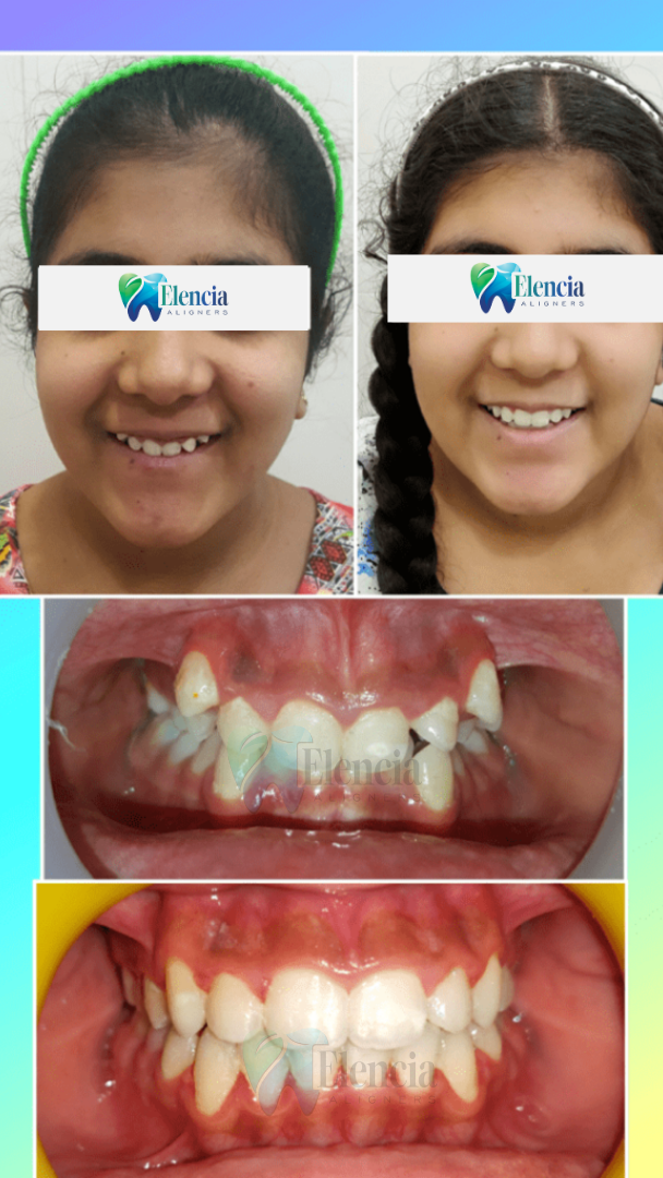 elencia aligners treatment before after image