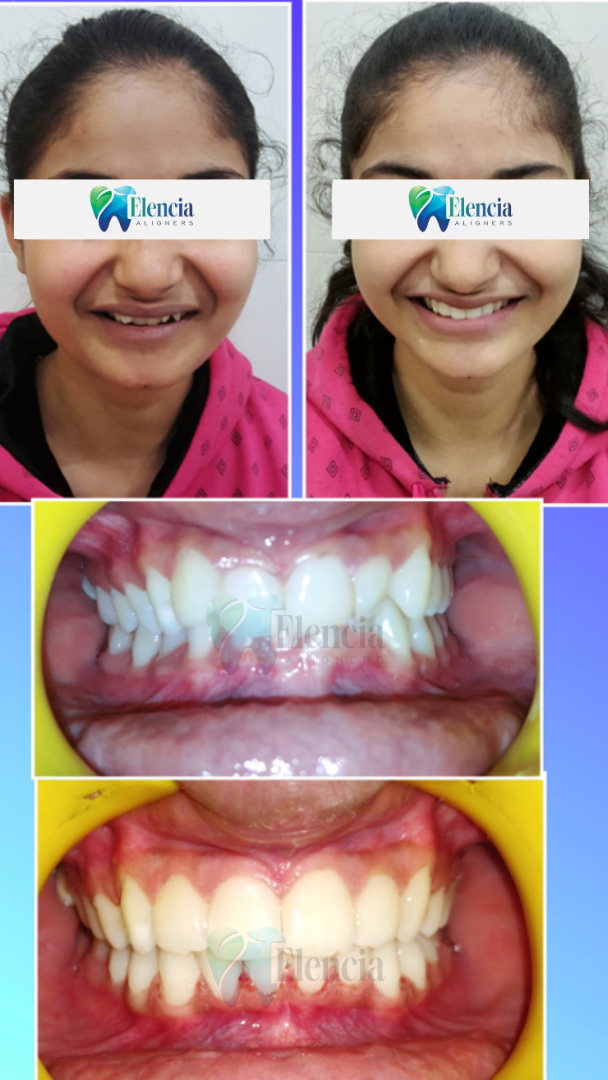 elencia aligners treatment before after image