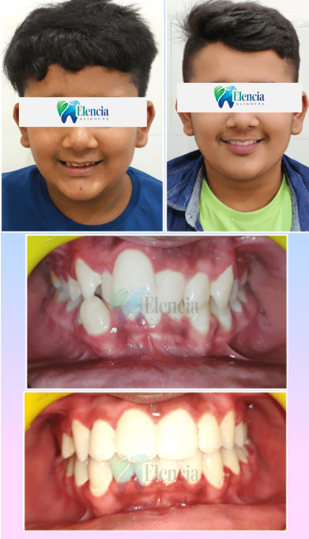 elencia aligners treatment before after image
