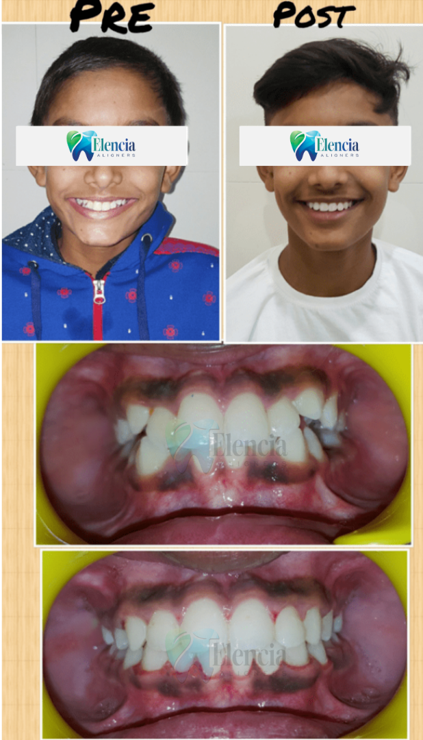 elencia aligners treatment before after image
