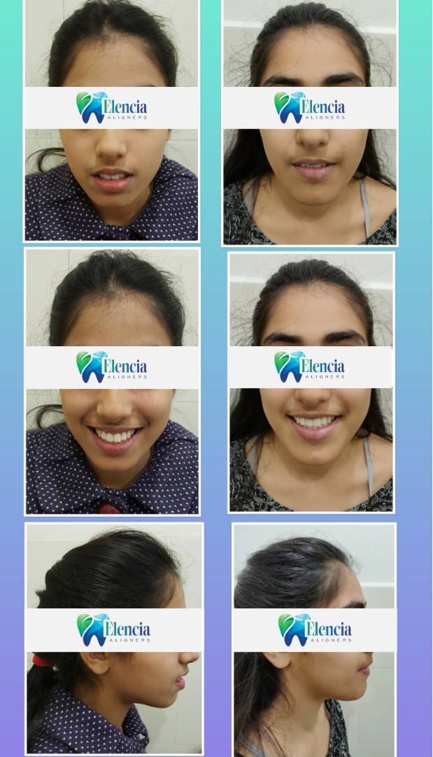 elencia aligners treatment before after image