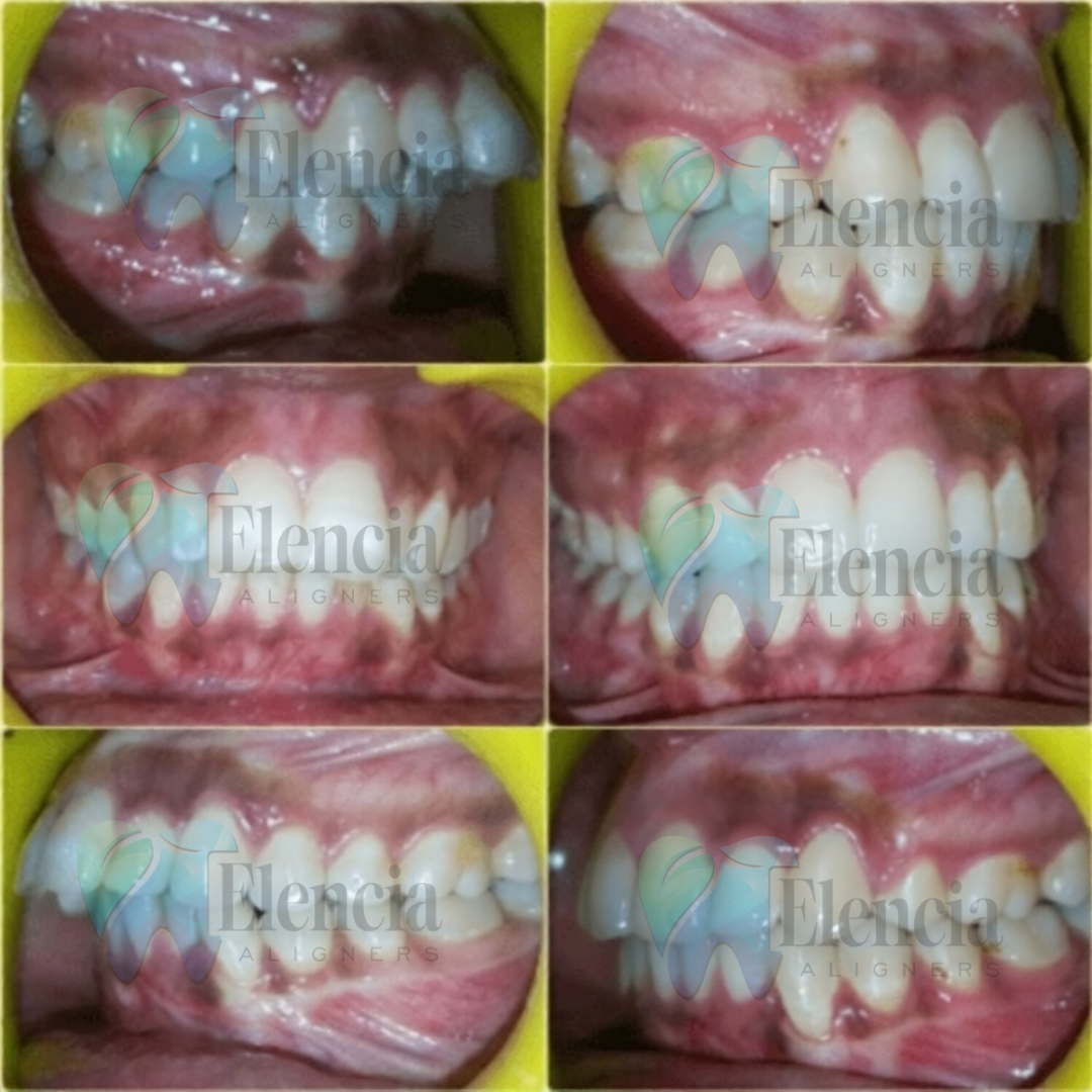 elencia aligners treatment before after image
