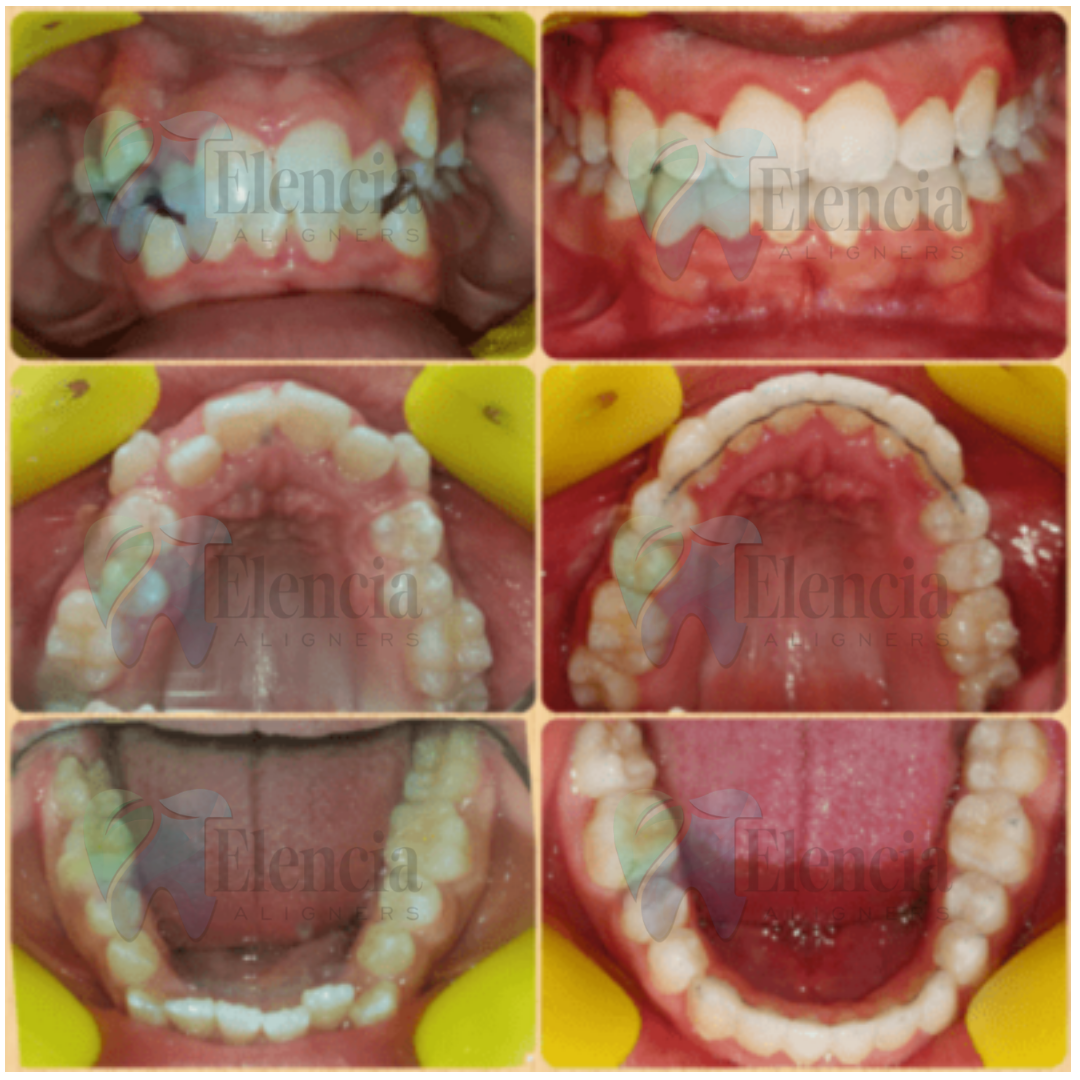 elencia aligners treatment before after image