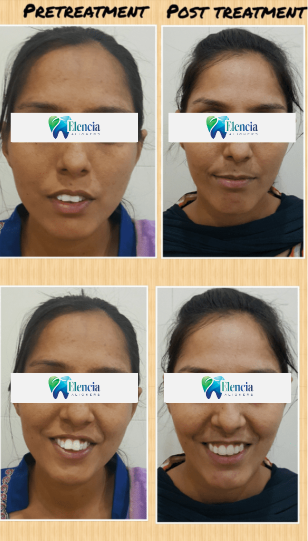 elencia aligners treatment before after image