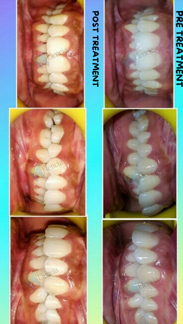 elencia aligners treatment before after image