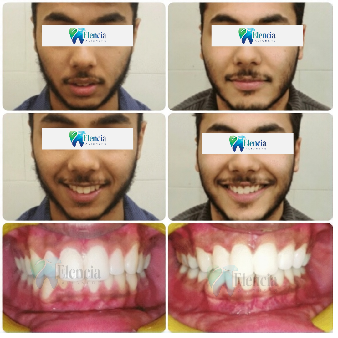 elencia aligners treatment before after image