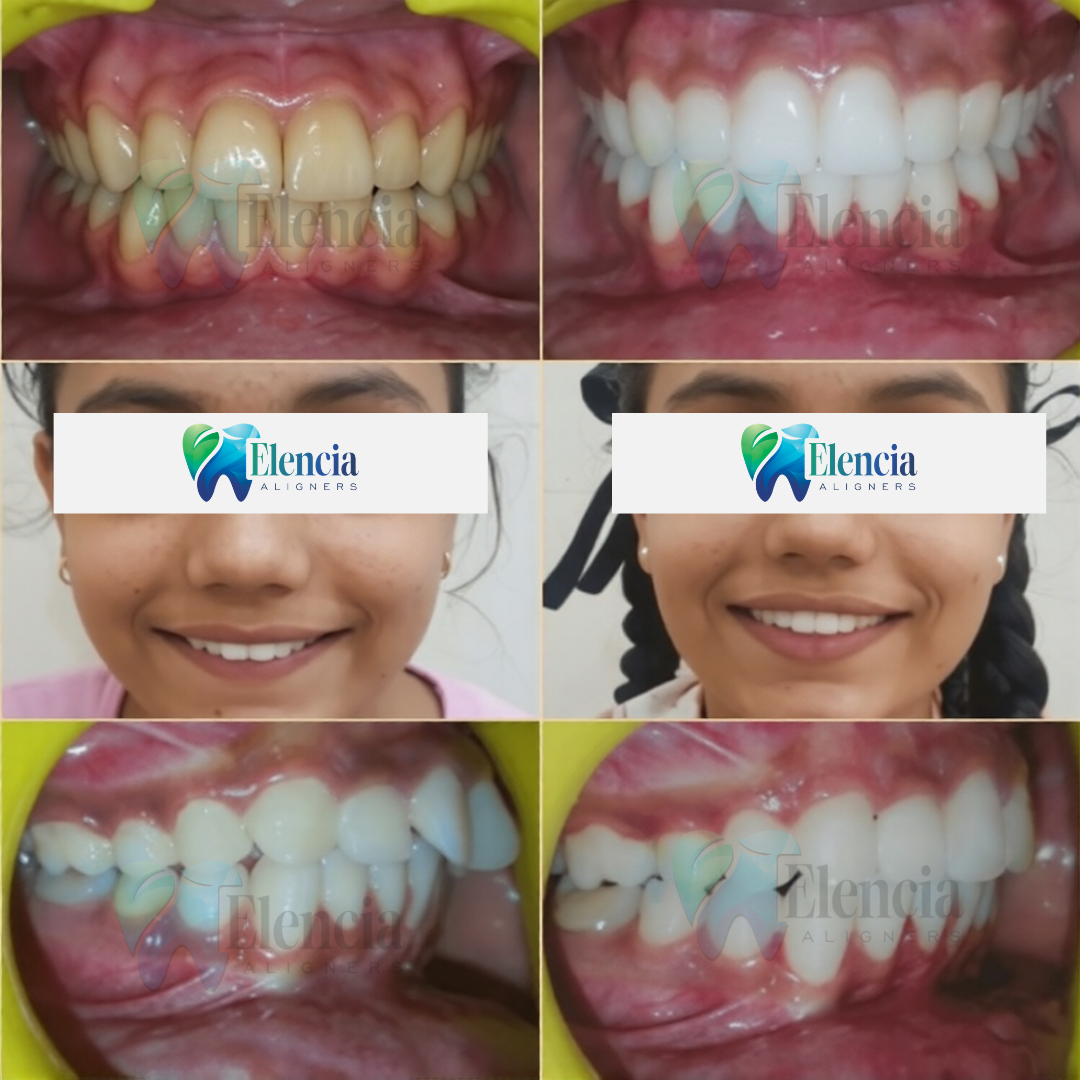 elencia aligners treatment before after image