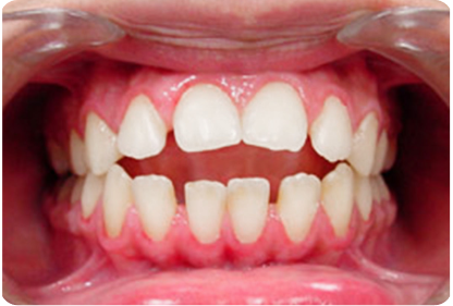 Severe spacing and alignment issues treatable with aligners