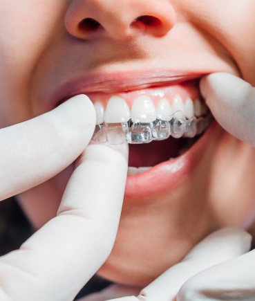 Orthodontist fitting clear aligners for precise tooth movement