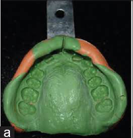Dental impression model for aligner treatment planning