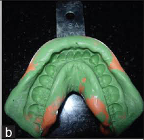 Dental impression used for custom clear aligner fabrication