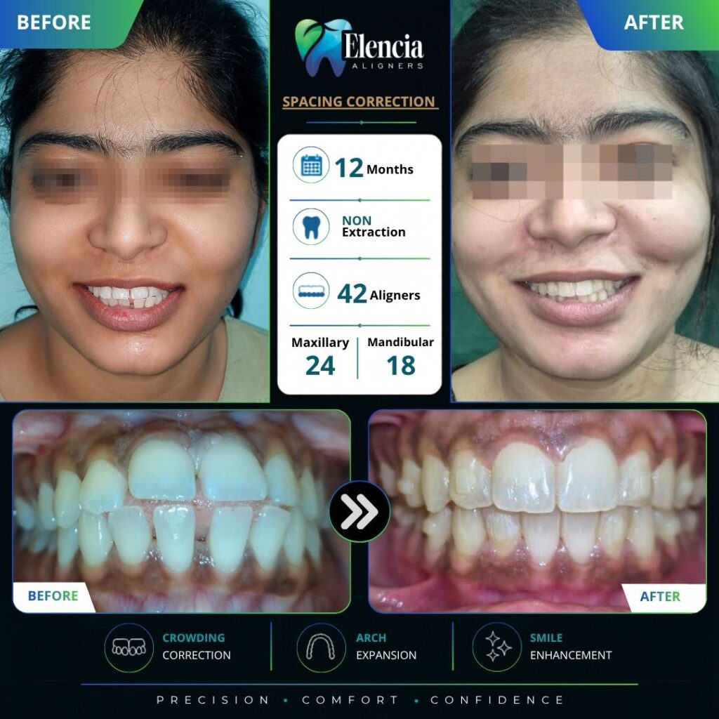 elencia aligners before after