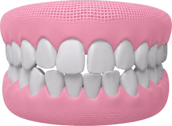 Braces-After