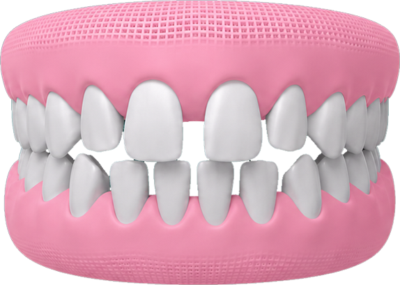 Spacing-Teeth-img