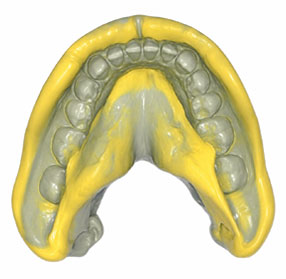 aligners impression