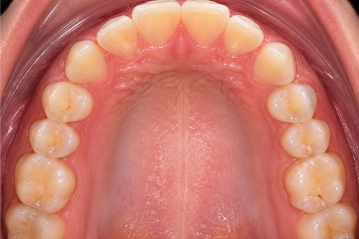 Maxillary Occlusal View