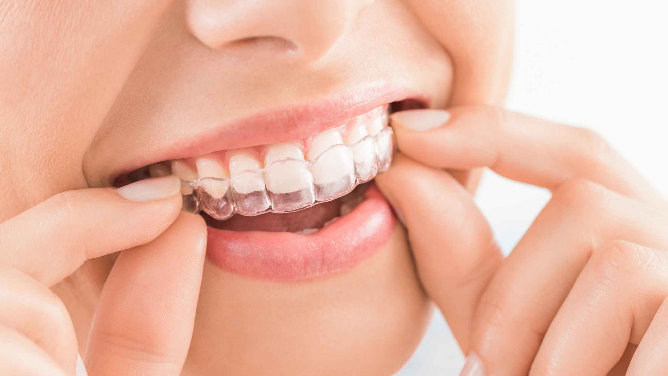 Clear aligner being placed over teeth during orthodontic treatment
