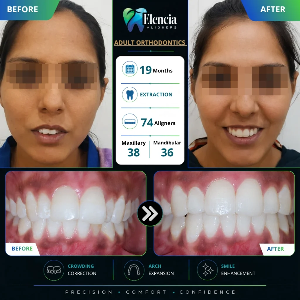 Before and after of adult orthodontic treatment with 74 Elencia clear aligners over 19 months, including extraction.