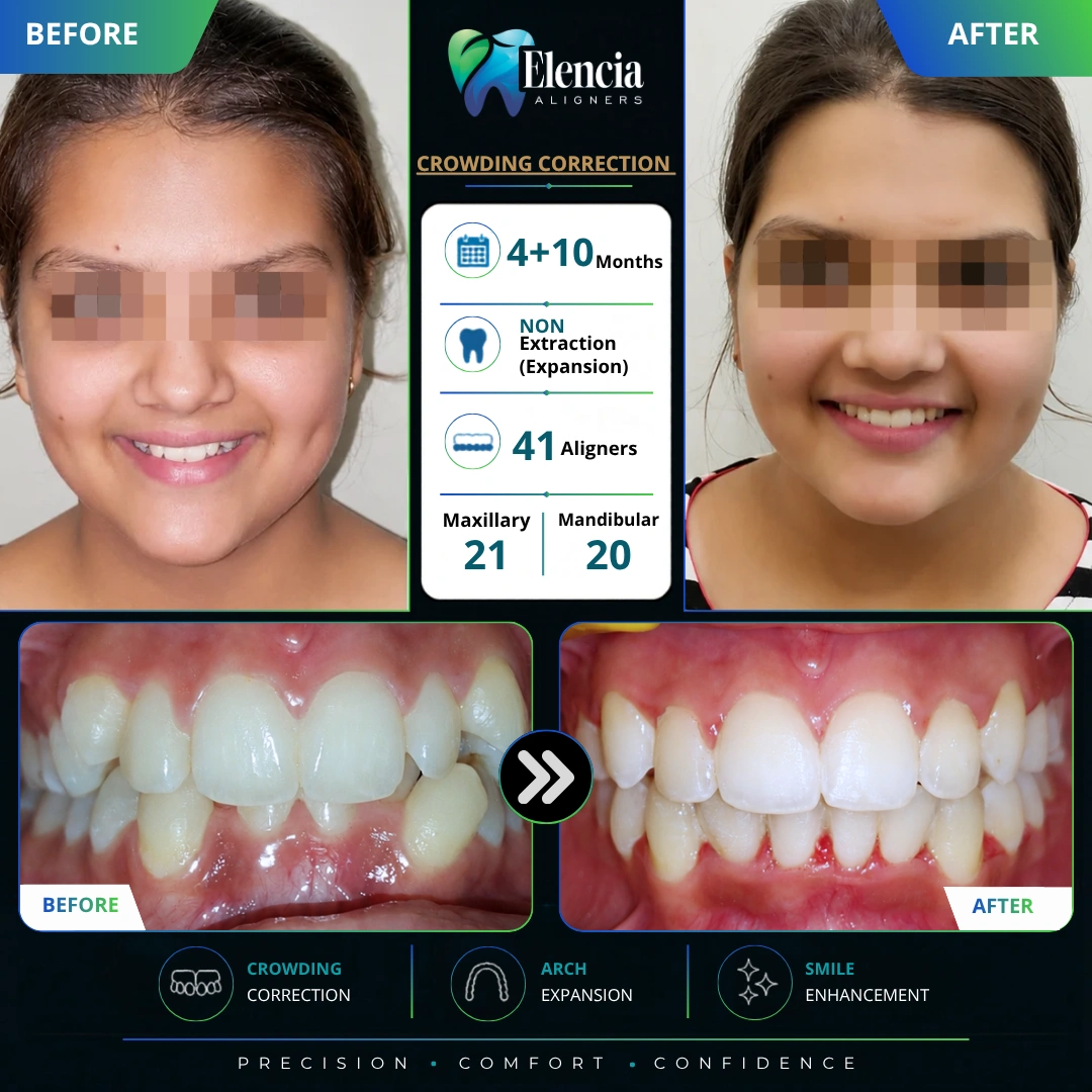 Before and after of crowding correction with 41 Elencia clear aligners over 14 months, using a non-extraction expansion approach.